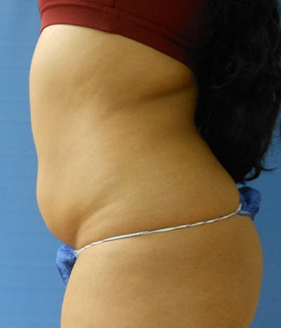 Abdomen Before & After Gallery - Patient 51821573 - Image 1