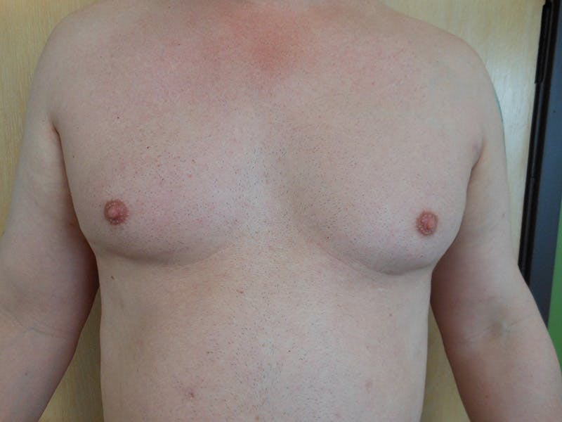 Gynecomastia Before & After Gallery - Patient 51821572 - Image 1