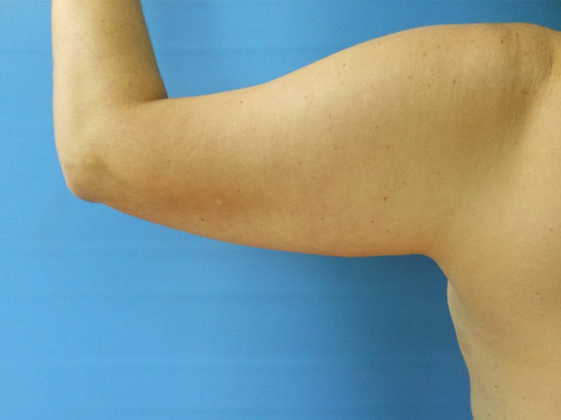 Arms Before & After Gallery - Patient 51821571 - Image 5