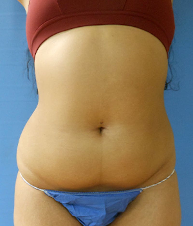 Abdomen Before & After Gallery - Patient 51821573 - Image 3