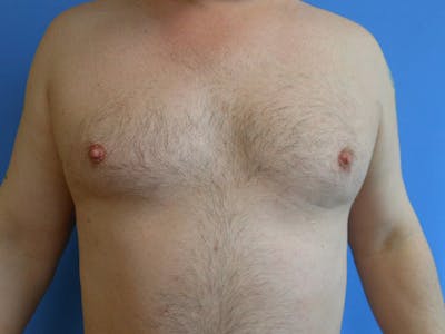 Gynecomastia Before & After Gallery - Patient 51821572 - Image 2