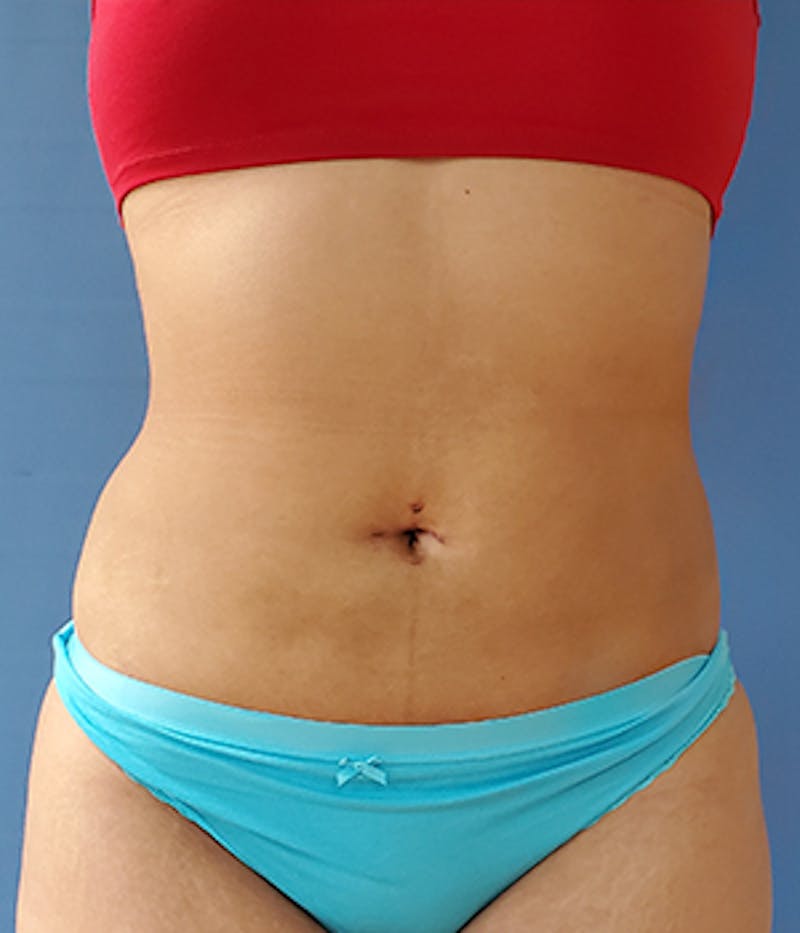 Abdomen Before & After Gallery - Patient 51821573 - Image 4