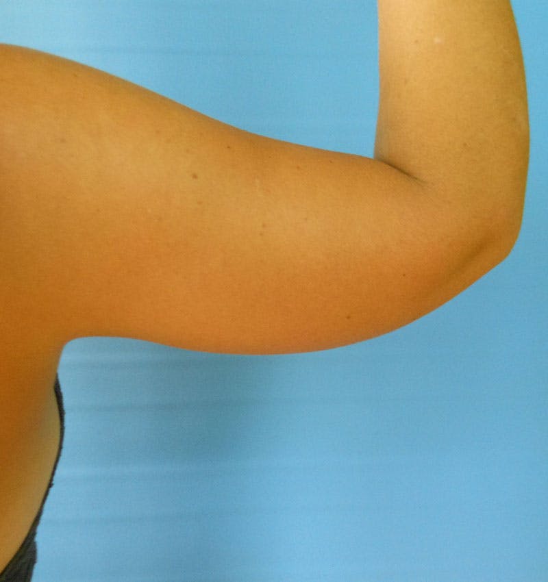 Arms Before & After Gallery - Patient 51821575 - Image 1