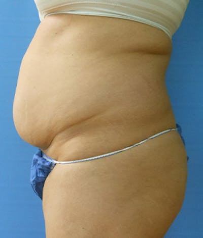Abdomen Before & After Gallery - Patient 51821576 - Image 1