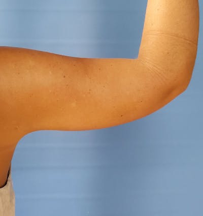 Arms Before & After Gallery - Patient 51821575 - Image 2