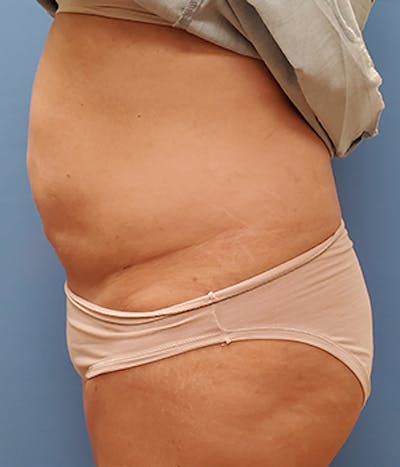 Abdomen Before & After Gallery - Patient 51821576 - Image 2