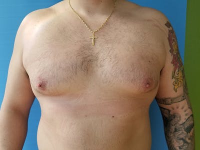 Gynecomastia Before & After Gallery - Patient 51821578 - Image 2