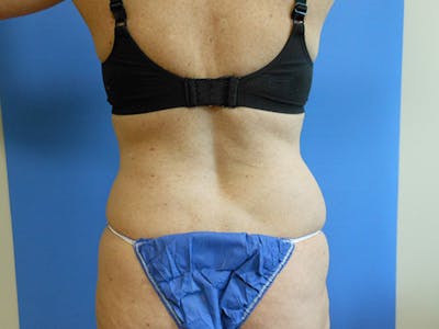 Lower Back Before & After Gallery - Patient 51821583 - Image 1