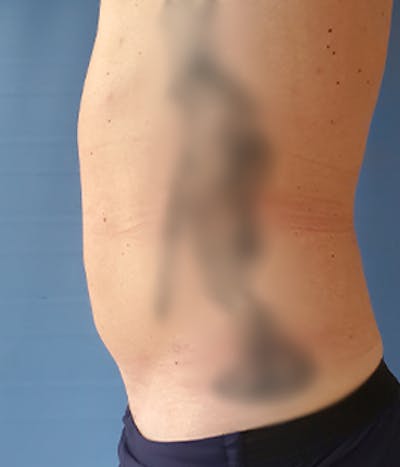 Abdomen Before & After Gallery - Patient 51821586 - Image 2