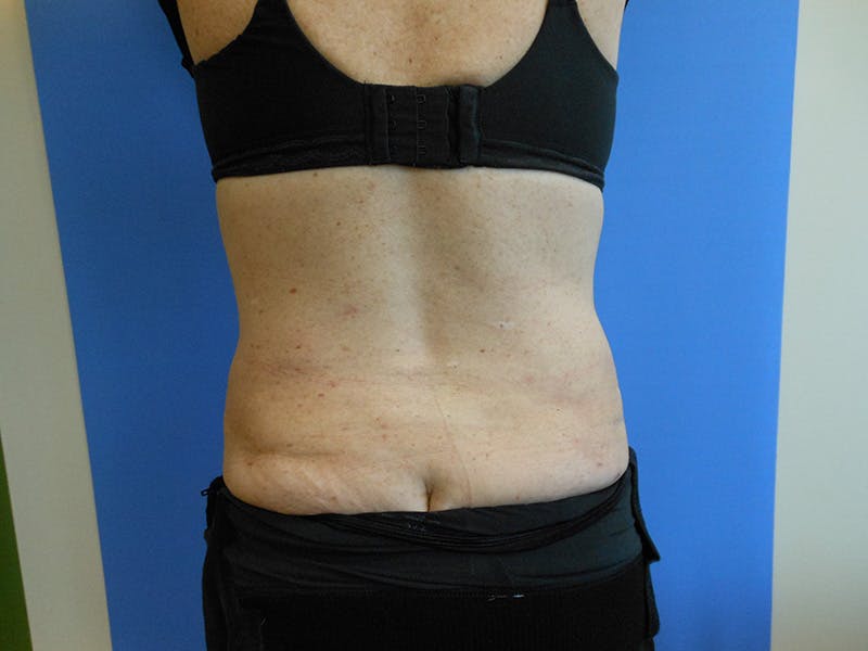 Lower Back Before & After Gallery - Patient 51821583 - Image 2