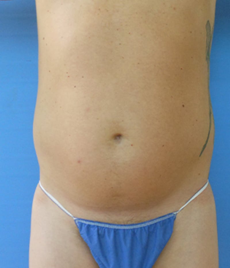 Abdomen Before & After Gallery - Patient 51821586 - Image 3