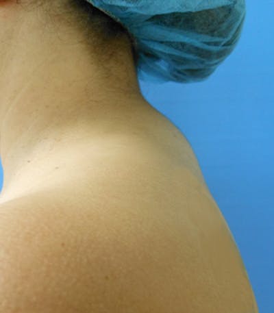 Buffalo Hump Before & After Gallery - Patient 51821585 - Image 1