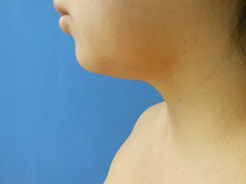 Neck Before & After Gallery - Patient 51821589 - Image 1