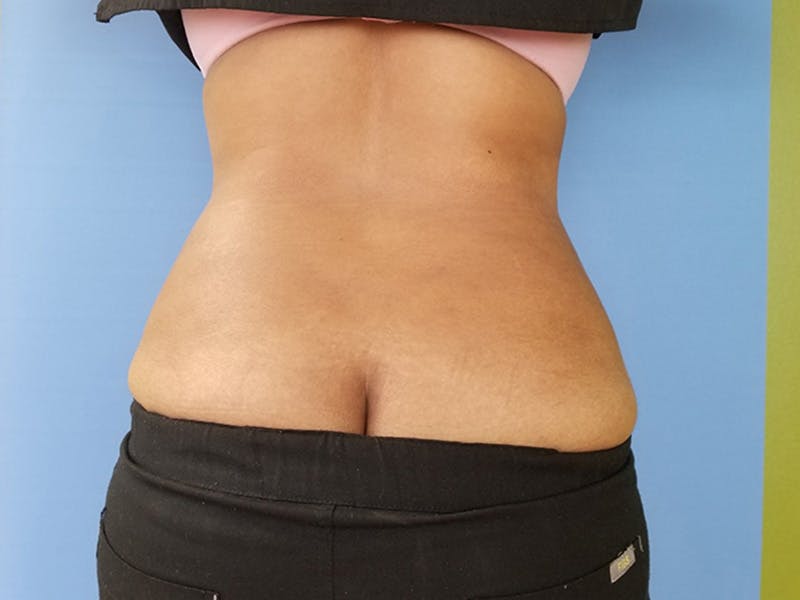 Lower Back Before & After Gallery - Patient 51821588 - Image 2