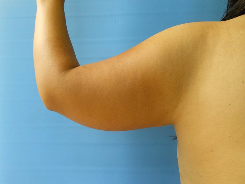 Arms Before & After Gallery - Patient 51821590 - Image 3