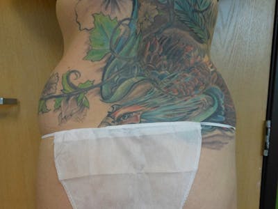 Lower Back Before & After Gallery - Patient 51821591 - Image 1