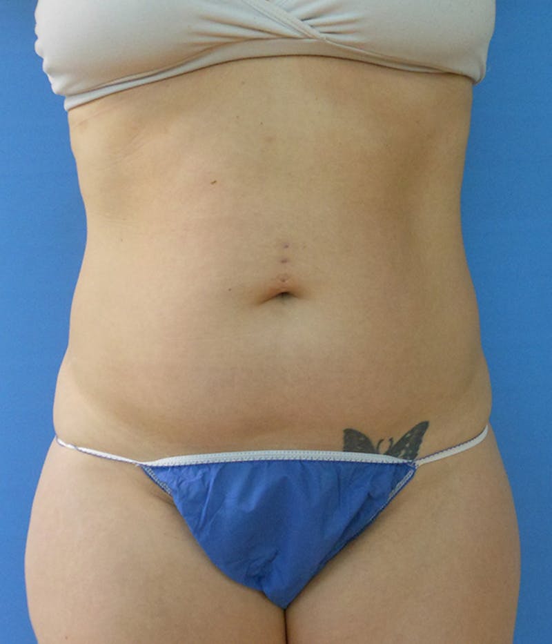 Abdomen Before & After Gallery - Patient 51821592 - Image 3