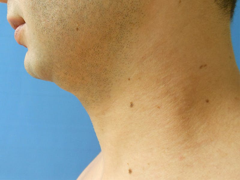 Neck Before & After Gallery - Patient 51821593 - Image 1
