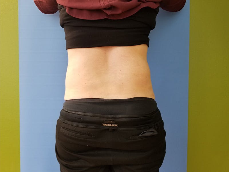 Lower Back Before & After Gallery - Patient 51821594 - Image 2