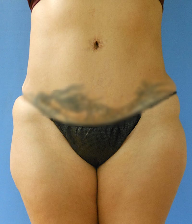 Outer Thigh Before & After Gallery - Patient 51821596 - Image 1