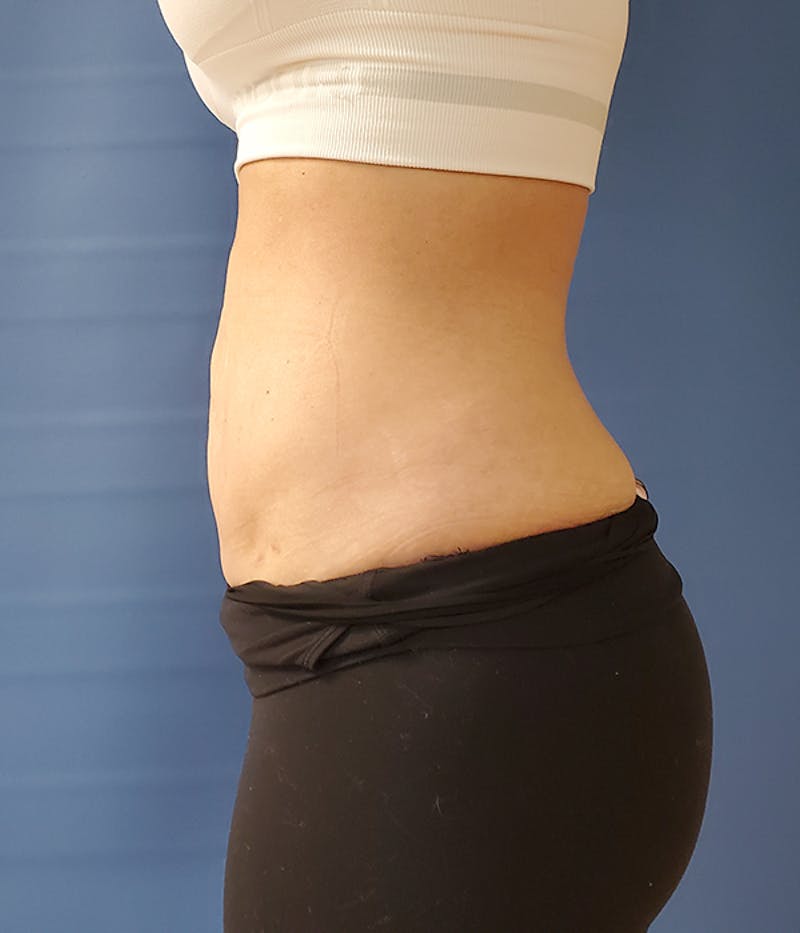Abdomen Before & After Gallery - Patient 51821599 - Image 2