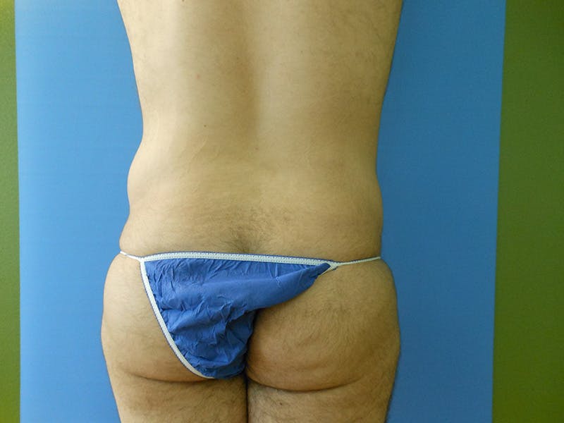 Lower Back Before & After Gallery - Patient 51821597 - Image 1