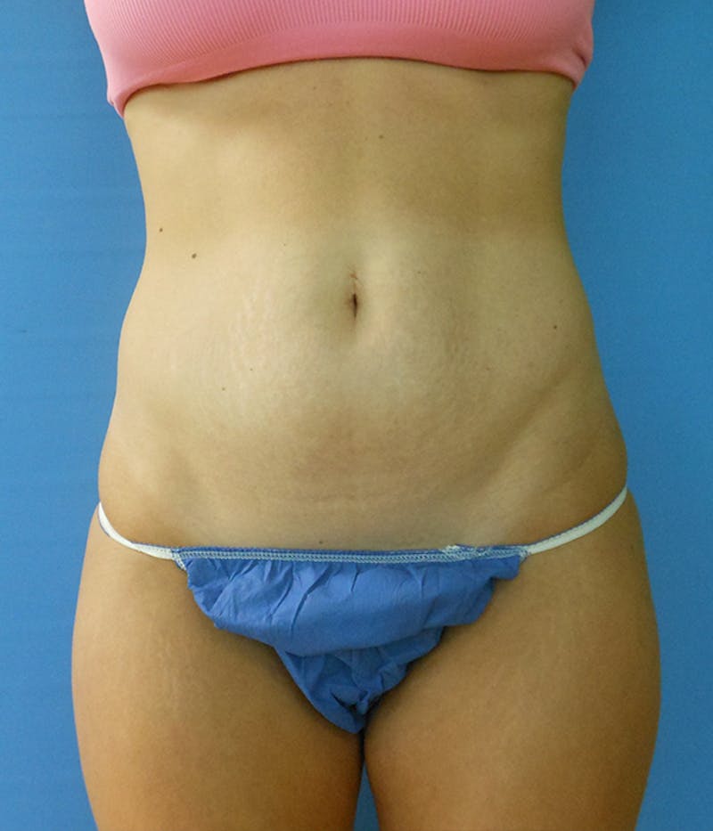 Abdomen Before & After Gallery - Patient 51821599 - Image 3