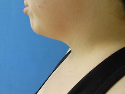 Neck Before & After Gallery - Patient 51821598 - Image 1