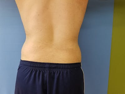 Lower Back Before & After Gallery - Patient 51821597 - Image 2