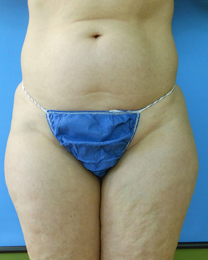 Outer Thigh Before & After Gallery - Patient 51821601 - Image 1