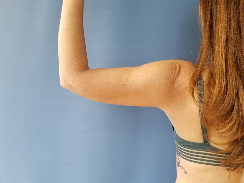 Arms Before & After Gallery - Patient 51821600 - Image 6