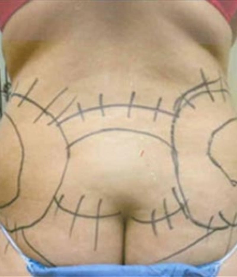 Lower Back Before & After Gallery - Patient 51821604 - Image 1