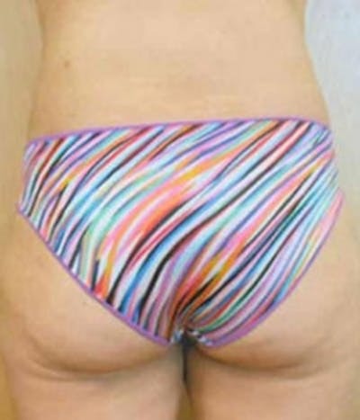 Lower Back Before & After Gallery - Patient 51821604 - Image 2