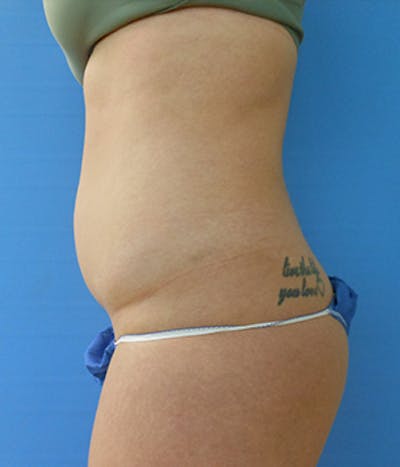 Abdomen Before & After Gallery - Patient 51821605 - Image 1