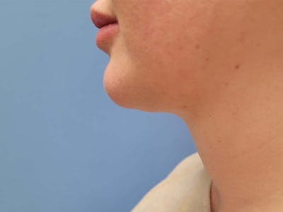 Neck Before & After Gallery - Patient 51821602 - Image 2