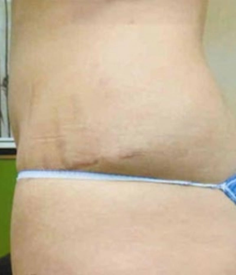 Lower Back Before & After Gallery - Patient 51821604 - Image 3