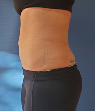 Abdomen Before & After Gallery - Patient 51821605 - Image 2