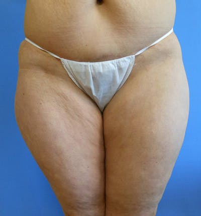 Outer Thigh Before & After Gallery - Patient 51821608 - Image 1