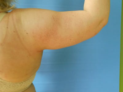 Arms Before & After Gallery - Patient 51821606 - Image 2
