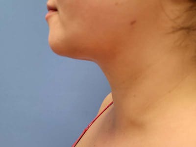 Neck Before & After Gallery - Patient 51821603 - Image 2
