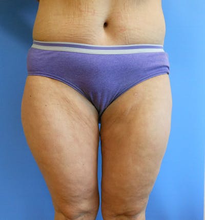 Outer Thigh Before & After Gallery - Patient 51821608 - Image 2