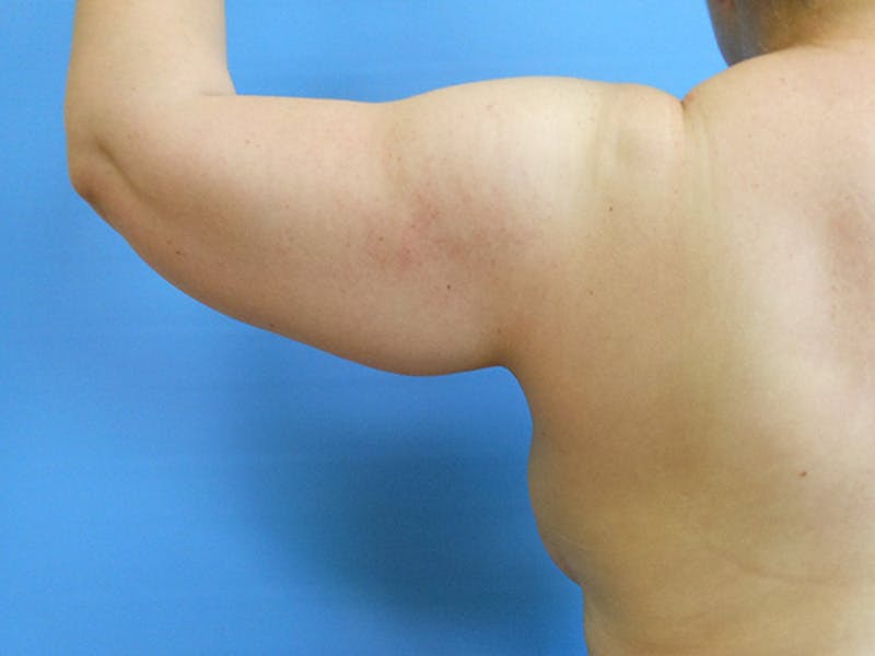 Arms Before & After Gallery - Patient 51821606 - Image 3