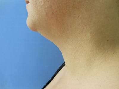 Neck Before & After Gallery - Patient 51821607 - Image 1