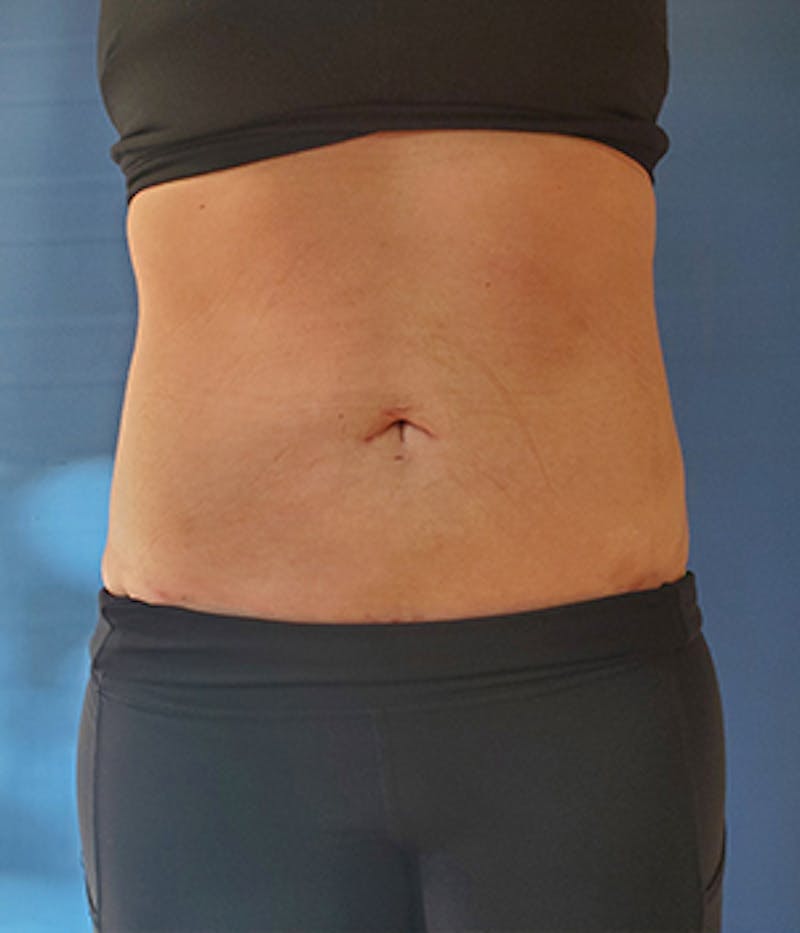 Abdomen Before & After Gallery - Patient 51821605 - Image 4
