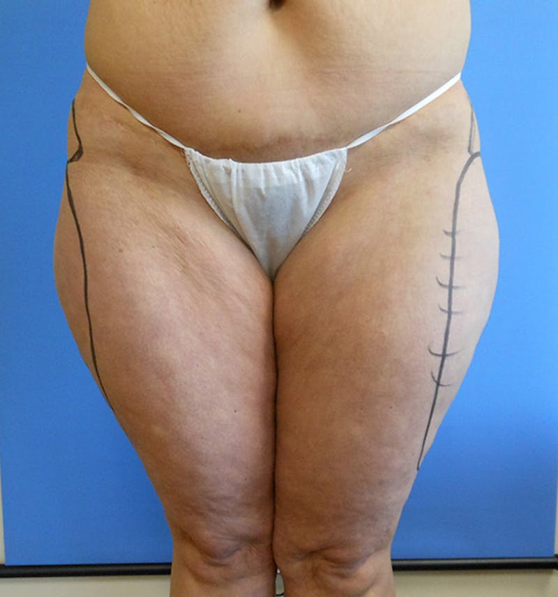 Outer Thigh Before & After Gallery - Patient 51821608 - Image 3