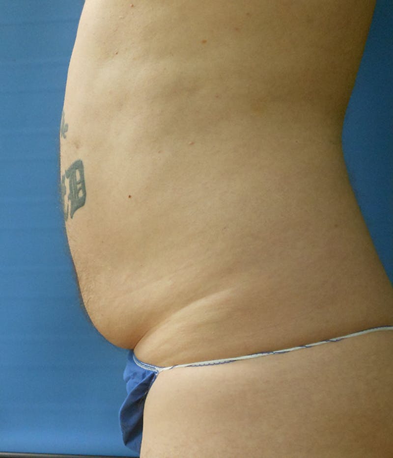 Abdomen Before & After Gallery - Patient 51821612 - Image 1