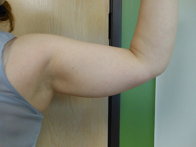 Arms Before & After Gallery - Patient 51821609 - Image 1