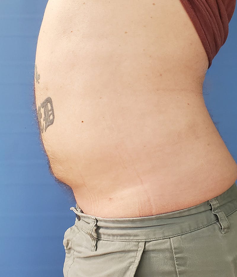 Abdomen Before & After Gallery - Patient 51821612 - Image 2