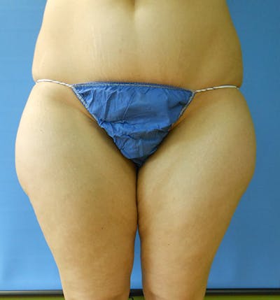 Outer Thigh Before & After Gallery - Patient 51821611 - Image 1