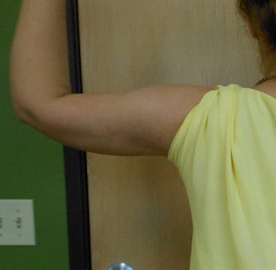 Arms Before & After Gallery - Patient 51821609 - Image 2